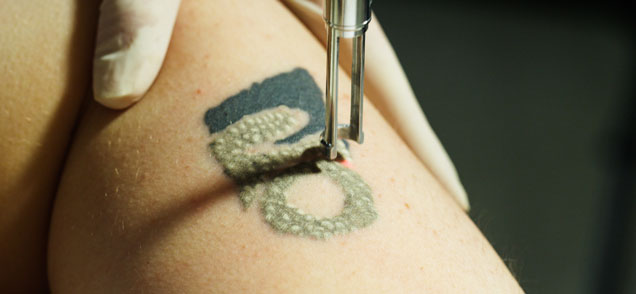 image of laser tattoo removal on shoulder