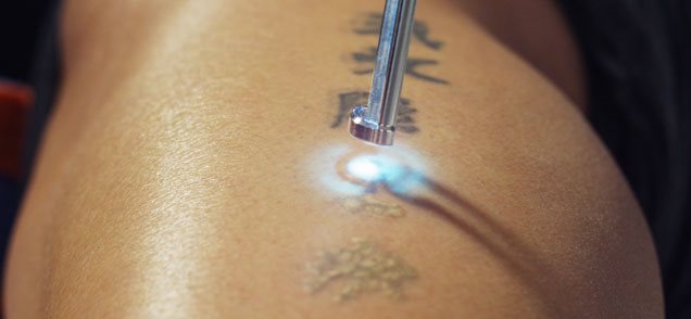 image of tattoo being lasered off woman's shoulder