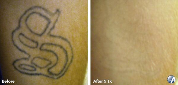 image of laser tattoo removal on leg