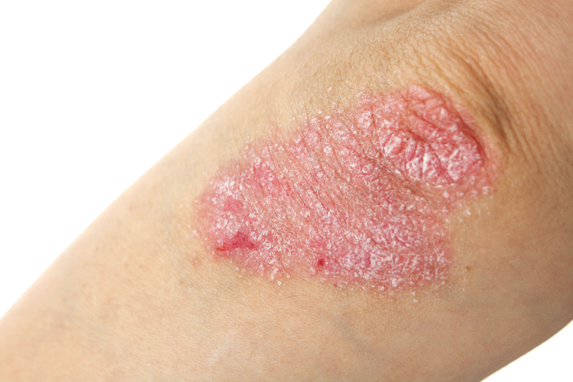Psoriasis-skin-on-the-elbow