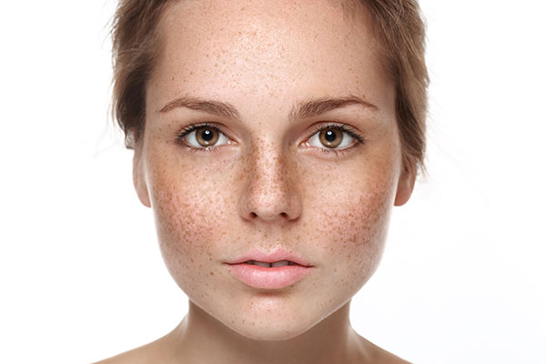 woman-with-actinic-keratosis-face